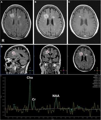 Case report: Anti-N-methyl-D-aspartate receptor antibody-associated autoimmunity triggered by primary central nervous system B-cell lymphoma